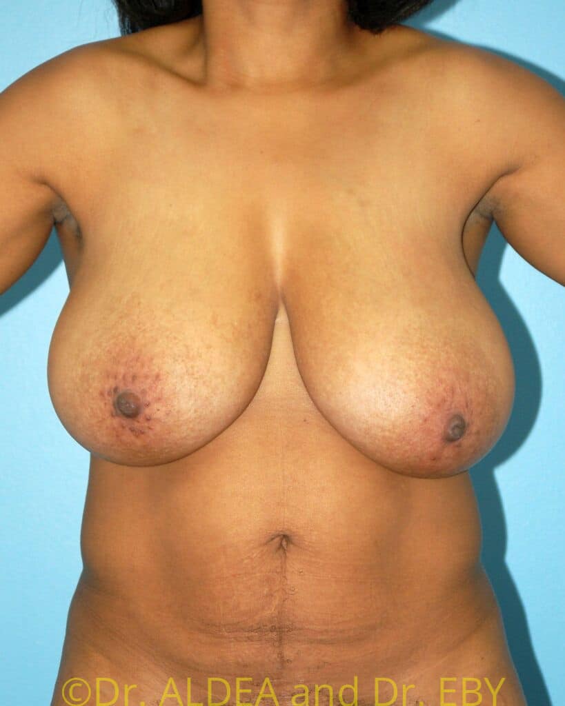 Before Image: Short Scar Breast Reduction #319 - front