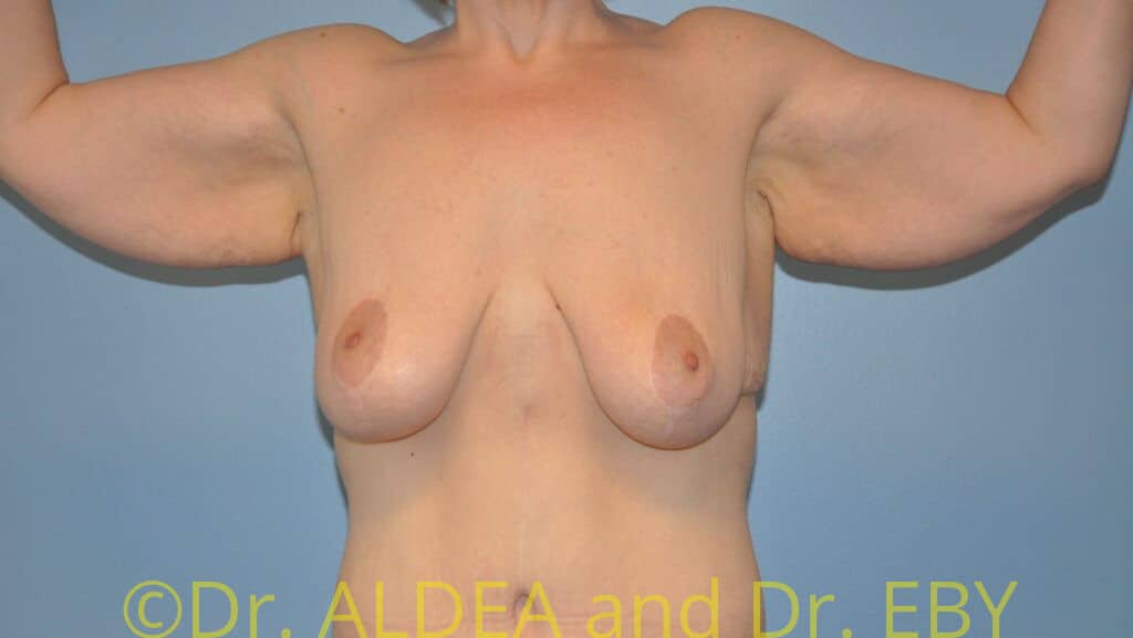Before Image: Brachioplasty #375 - front