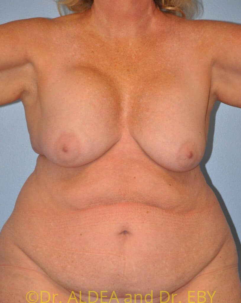 Before Image: Breast Implant Removal (Explantation) WITH a Lift #986 - front