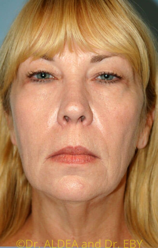 Before Image: Facelift #674 - front