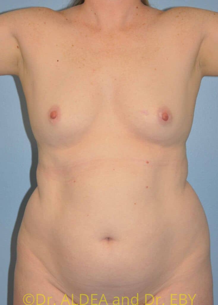 Before Image: Fat Transfer to Breasts #462 - front