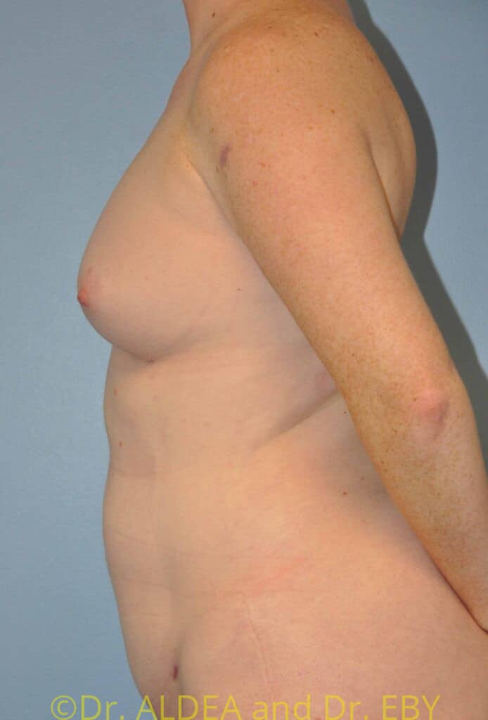 After Image: Fat Transfer to Breasts #462 - left-side