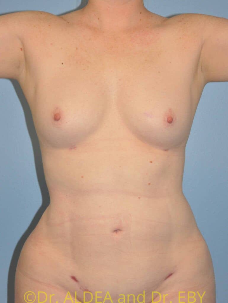 After Image: Fat Transfer to Breasts #462 - front