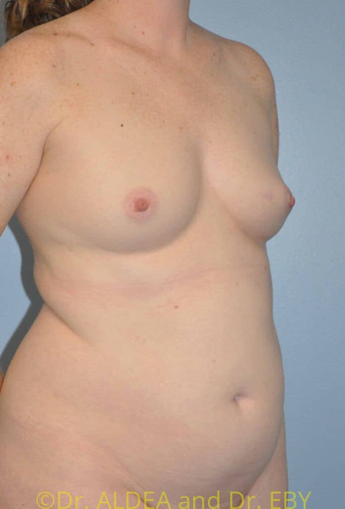 Before Image: Fat Transfer to Breasts #462 - right-front-oblique