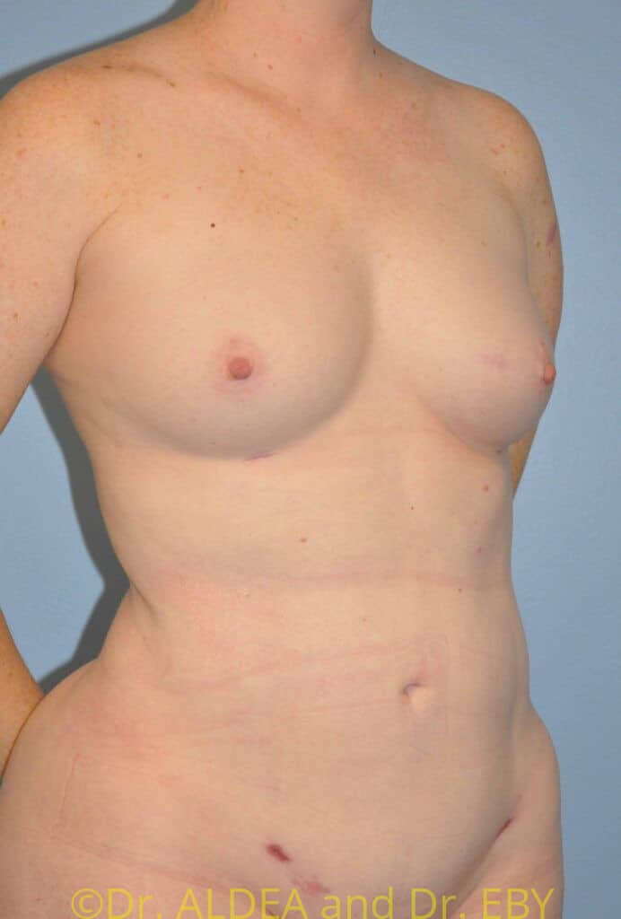 After Image: Fat Transfer to Breasts #462 - right-front-oblique