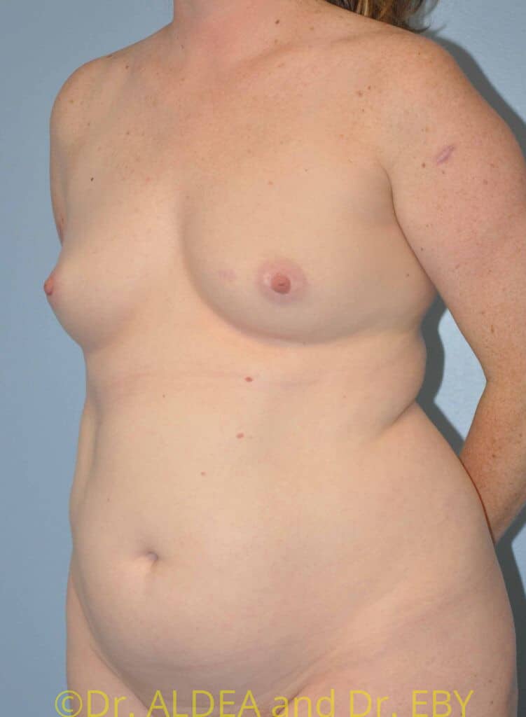 Before Image: Fat Transfer to Breasts #462 - left-front-oblique