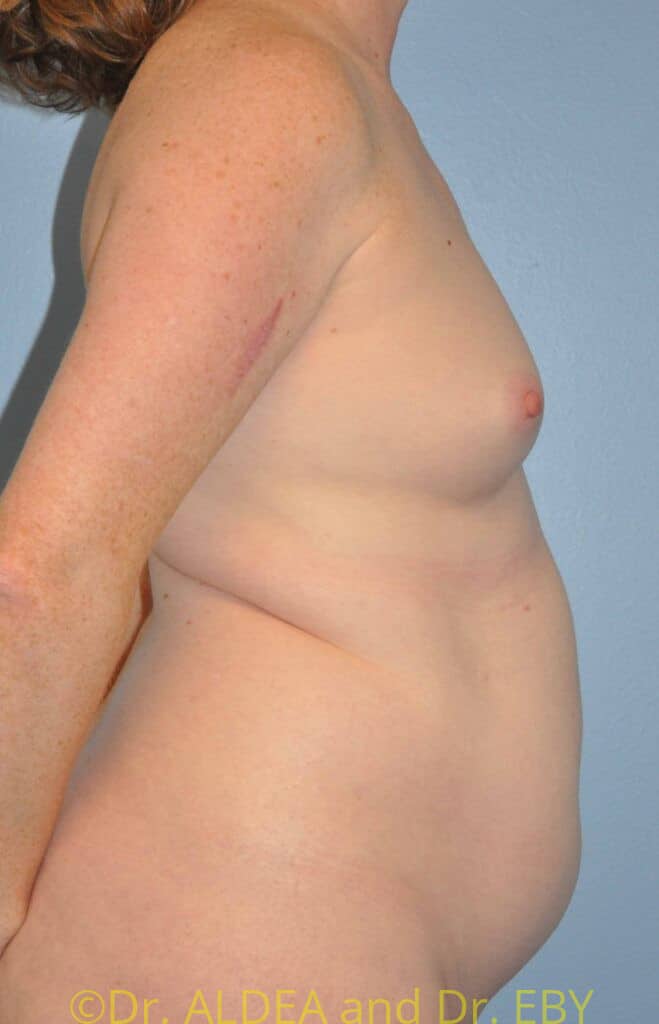 Before Image: Fat Transfer to Breasts #462 - right-side