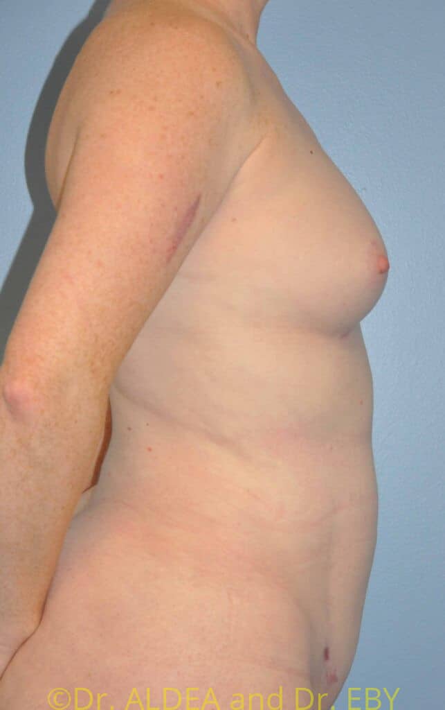 After Image: Fat Transfer to Breasts #462 - right-side