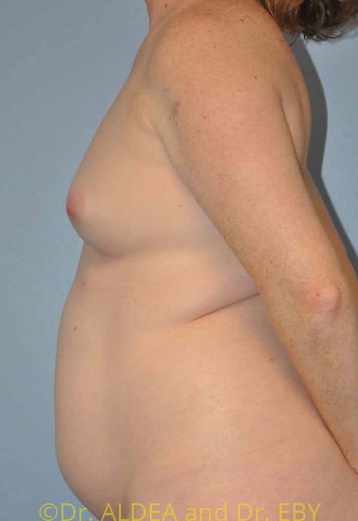 Before Image: Fat Transfer to Breasts #462 - left-side