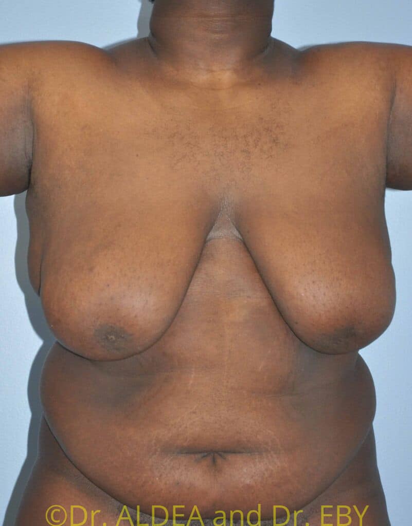 Before Image: Gynecomastia #798 - front