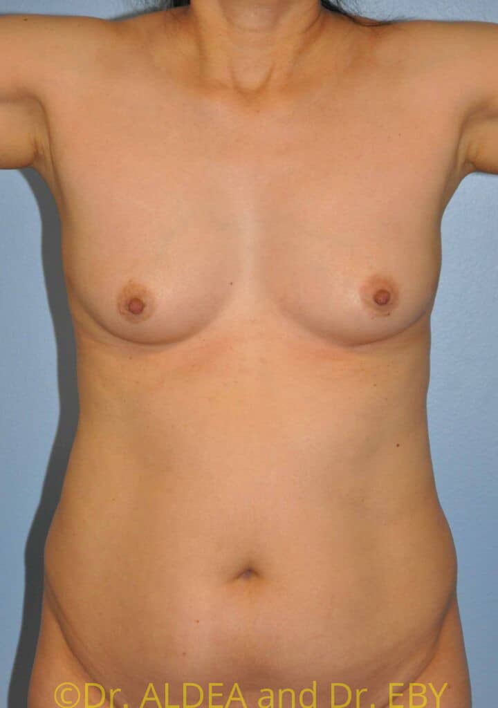 Before Image: Liposuction #318 - front