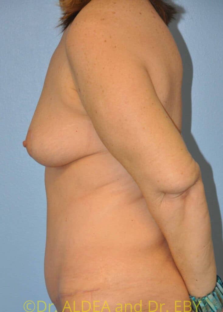 After Image: Mommy Makeover #638 - left-side