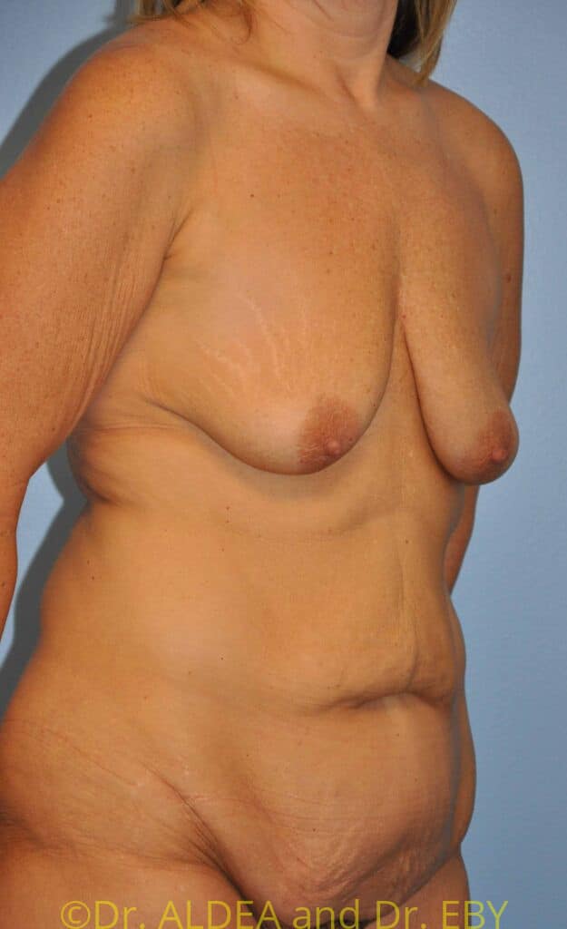 Before Image: Mommy Makeover #638 - right-front-oblique
