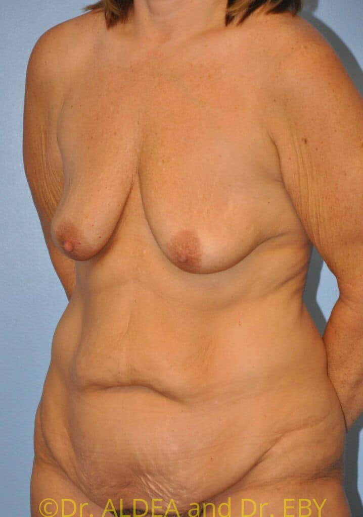 Before Image: Mommy Makeover #638 - left-front-oblique