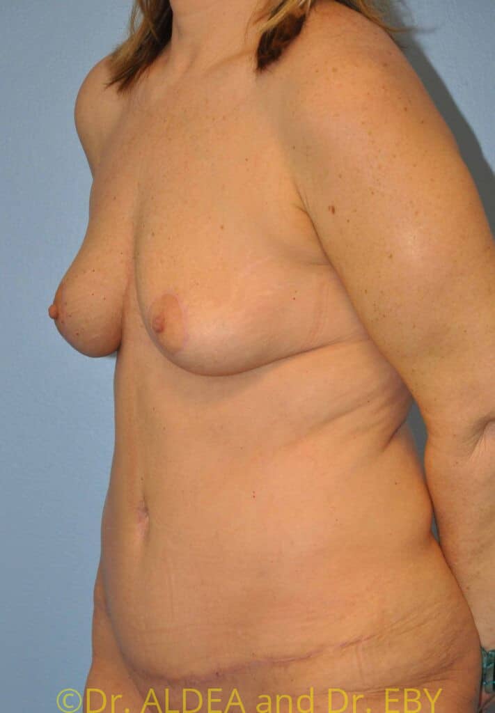 After Image: Mommy Makeover #638 - left-front-oblique