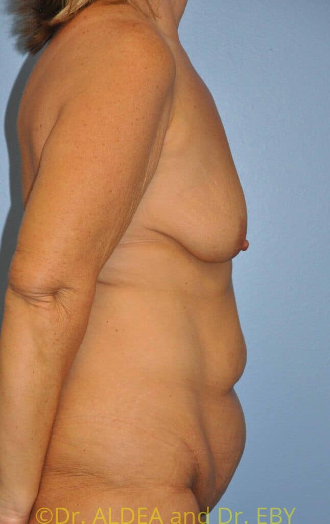 Before Image: Mommy Makeover #638 - right-side