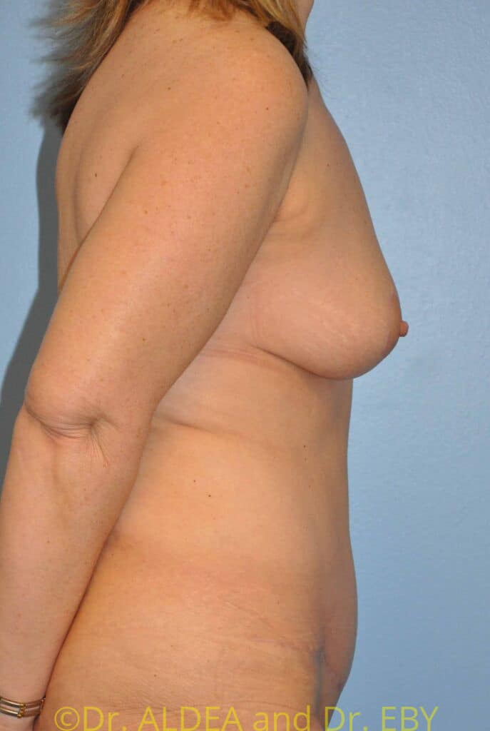After Image: Mommy Makeover #638 - right-side