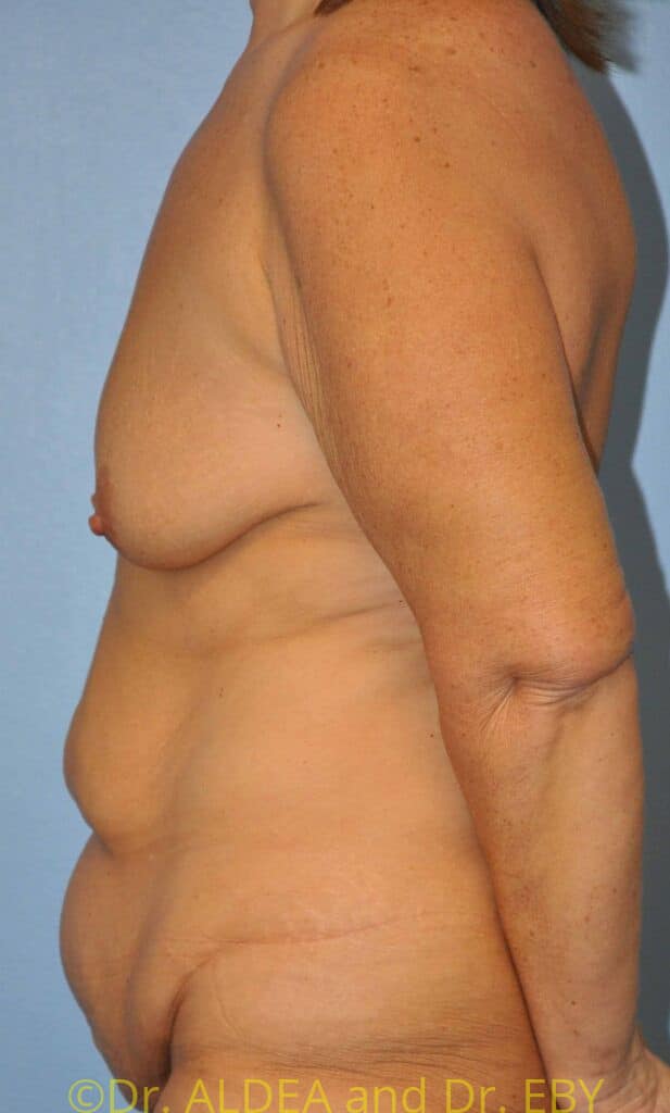 Before Image: Mommy Makeover #638 - left-side