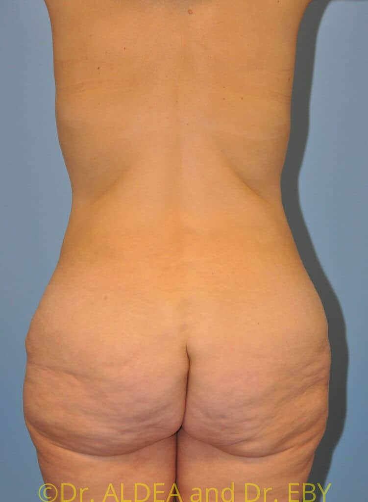 Before Image: Weight loss (MWL) Butt and Thigh Lift #669 - back