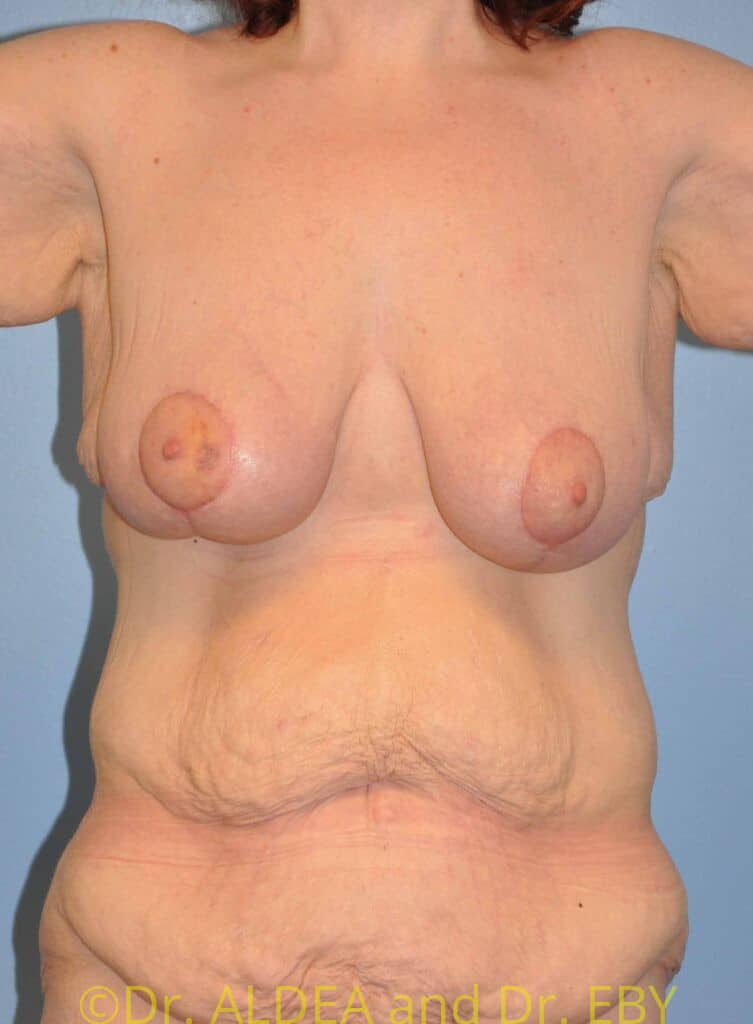 Before Image: Massive Weight Loss Tummy Tuck #375 - front