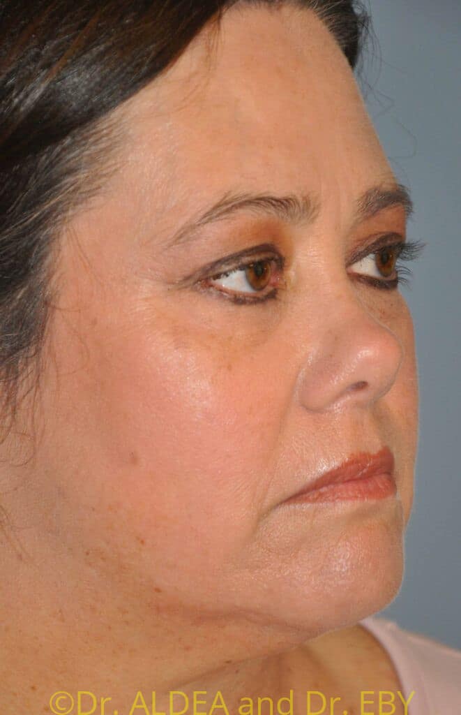 Before Image: Neck Liposuction #638 - right-front-oblique