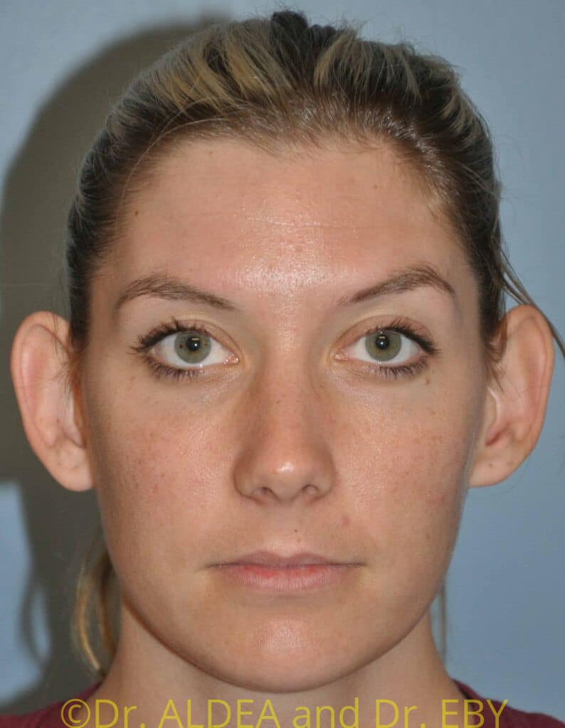 Before Image: Otoplasty (Prominent Ear Correction) #814 - front