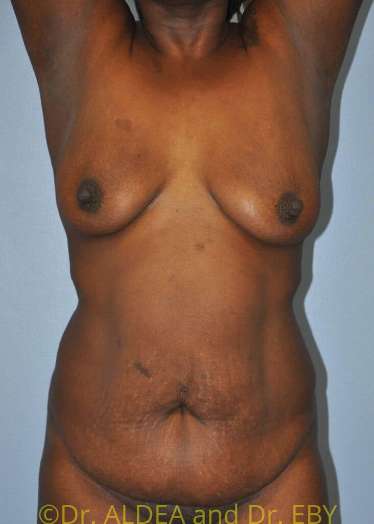 Before Image: Tummy Tuck #061 - front