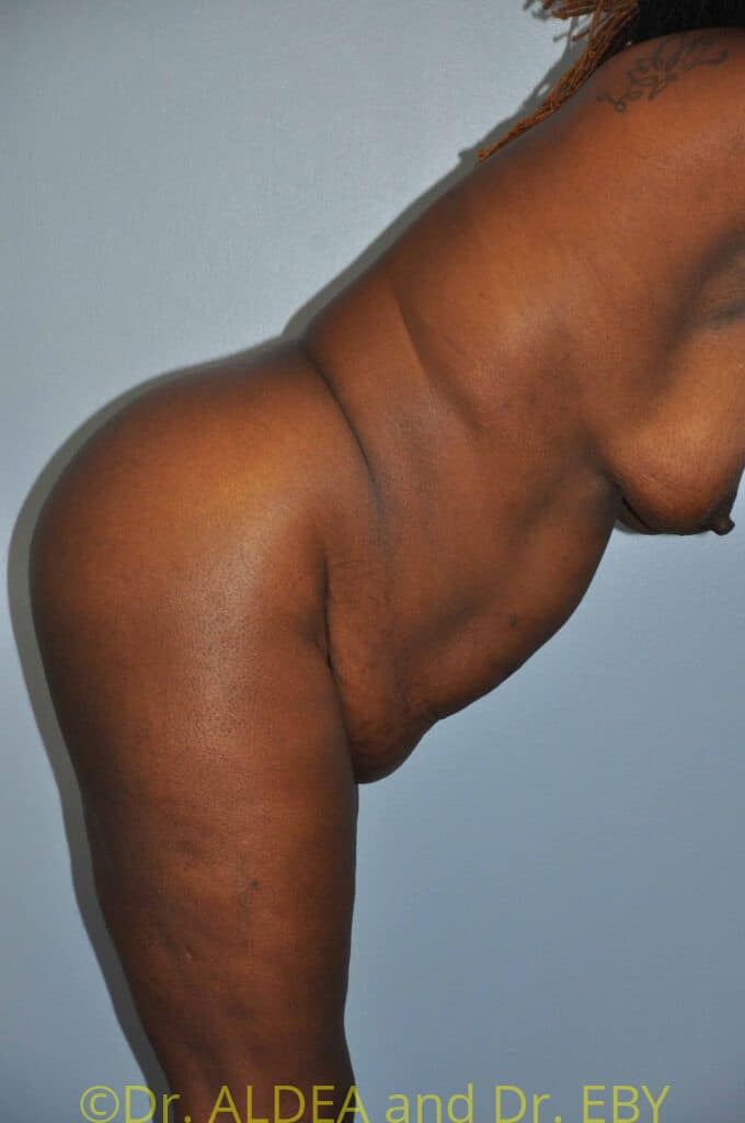 Before Image: Tummy Tuck #061 - other