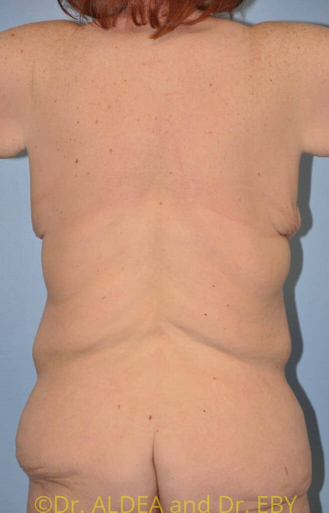 Before Image: Weight loss Upper Back (Bra Line) Lift (UBL) #375 - back