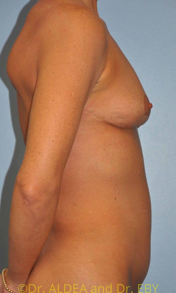 Before Image: Breast Augmentation w/ Lift #215 - right-side