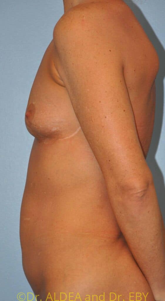 Before Image: Breast Augmentation w/ Lift #215 - left-side