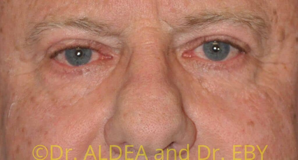 After Image: Blepharoplasty #439 - front