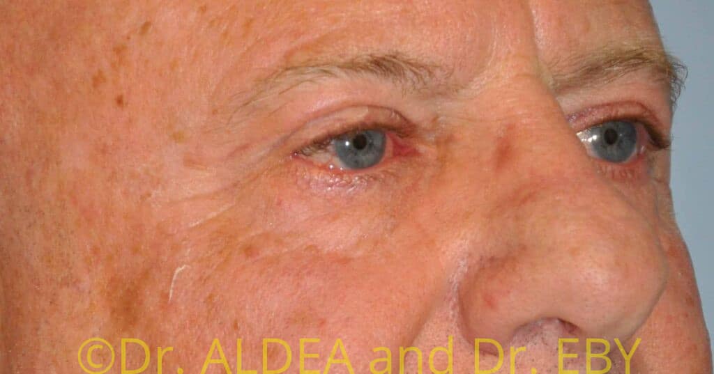 After Image: Blepharoplasty #439 - right-front-oblique