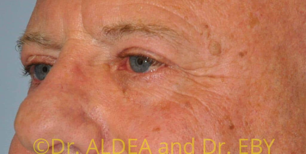 After Image: Blepharoplasty #439 - left-front-oblique