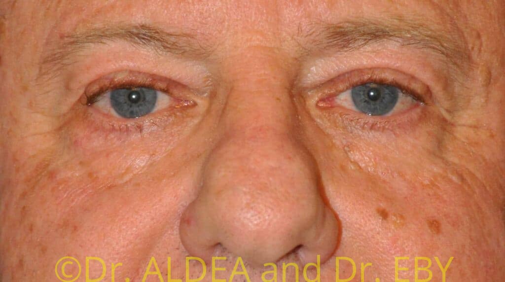 Before Image: Blepharoplasty #439 - front