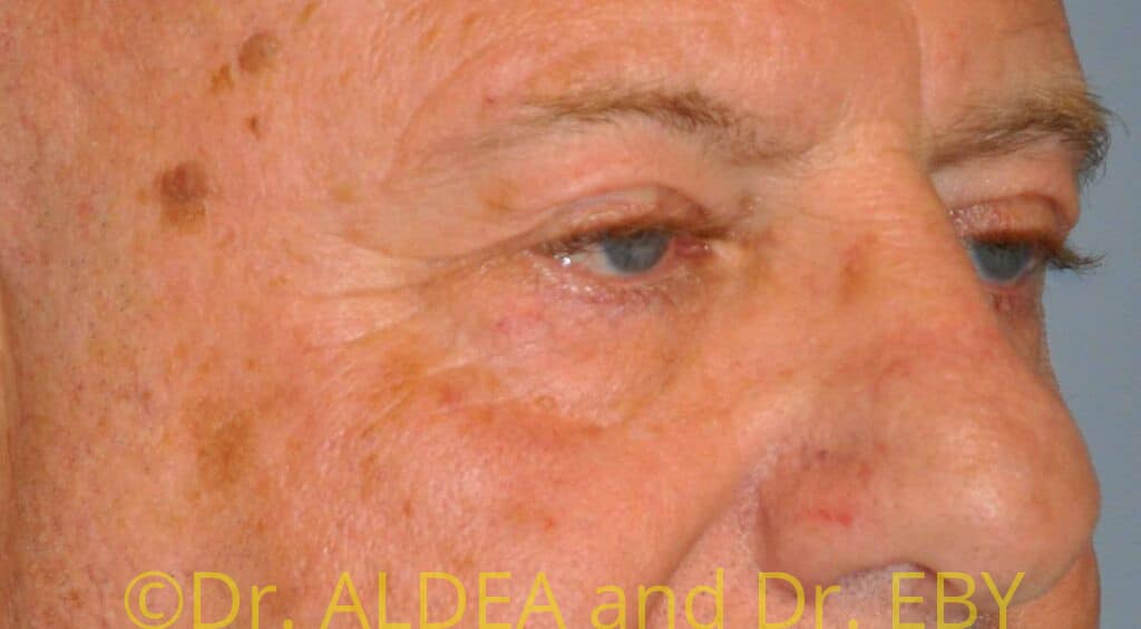 Before Image: Blepharoplasty #439 - right-front-oblique