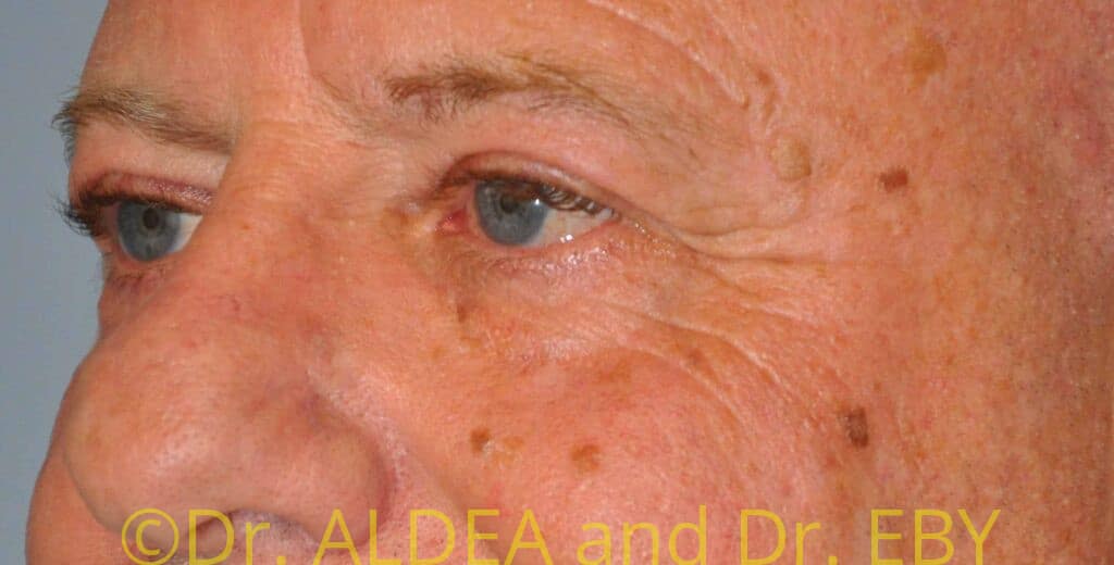 Before Image: Blepharoplasty #439 - left-front-oblique