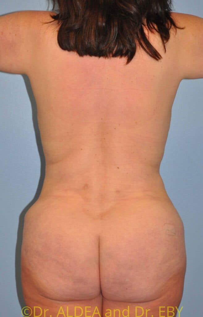 After Image: Back Scoop Liposuction #679 - back