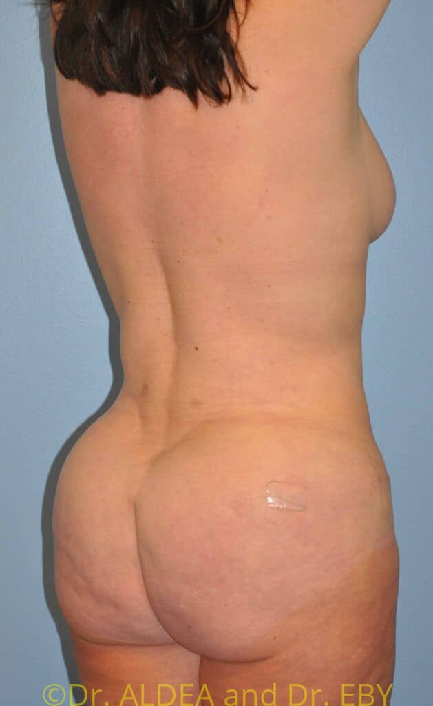 After Image: Back Scoop Liposuction #679 - right-back-oblique