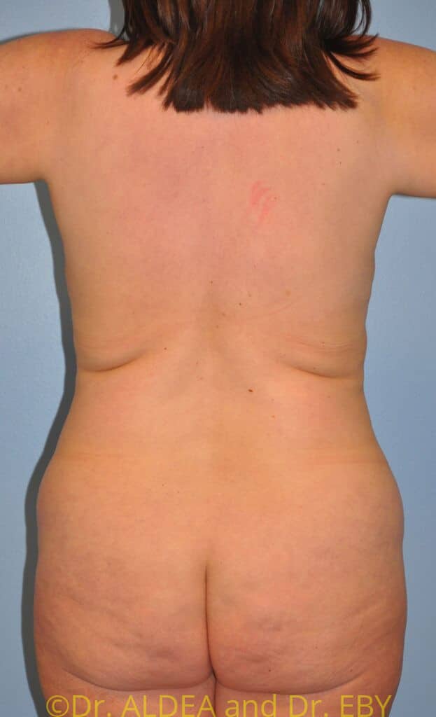 Before Image: Back Scoop Liposuction #679 - back