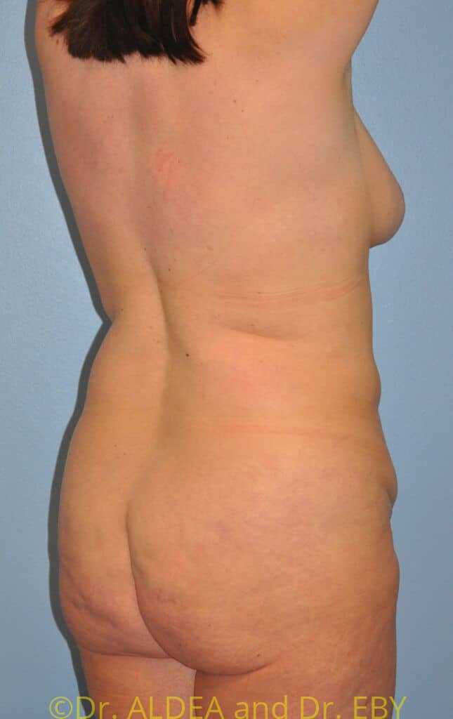 Before Image: Back Scoop Liposuction #679 - right-back-oblique