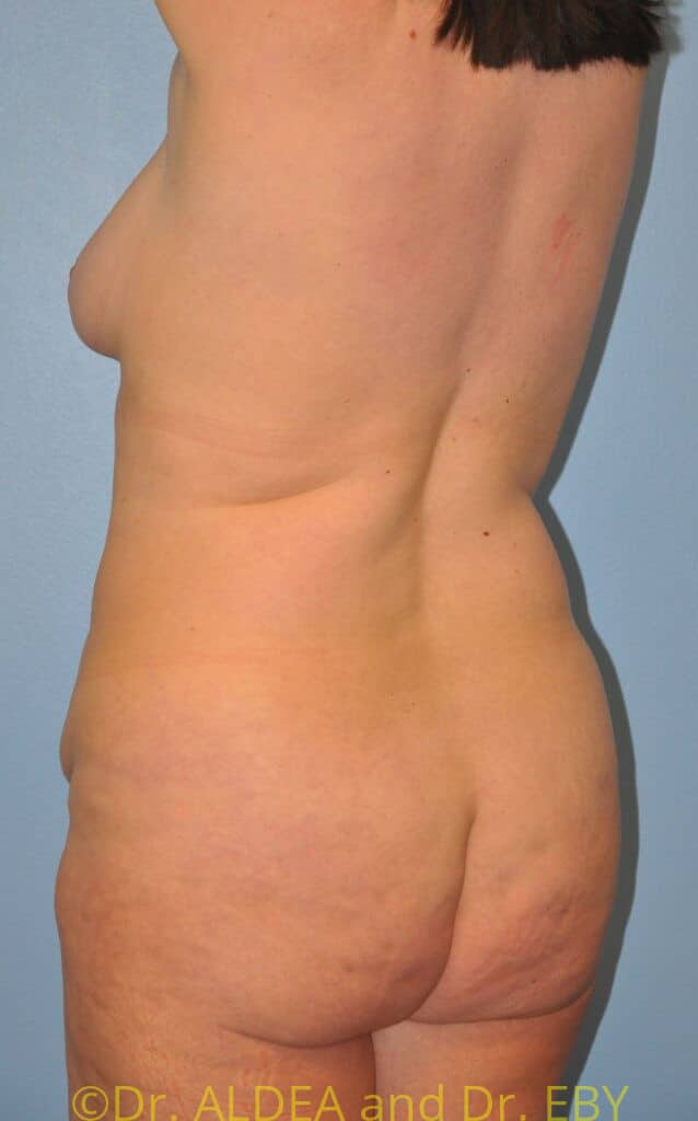 Before Image: Back Scoop Liposuction #679 - left-back-oblique