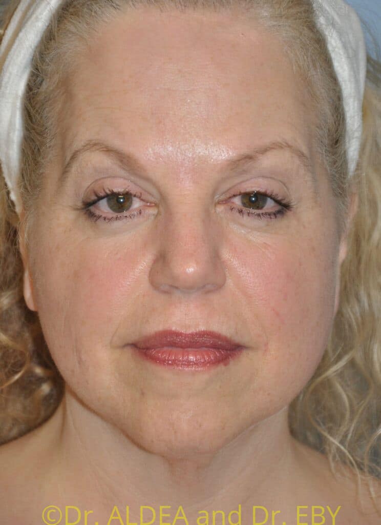 Before Image: Facelift #434 - front