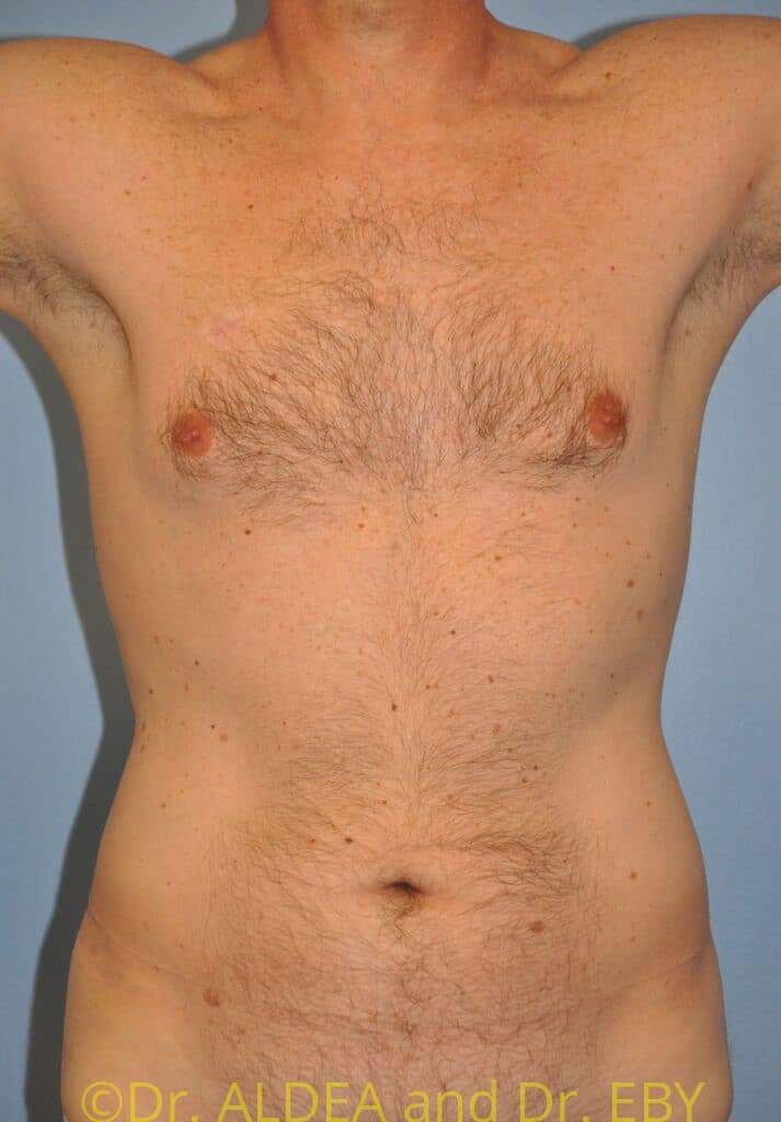 Before Image: Gynecomastia #922 - front