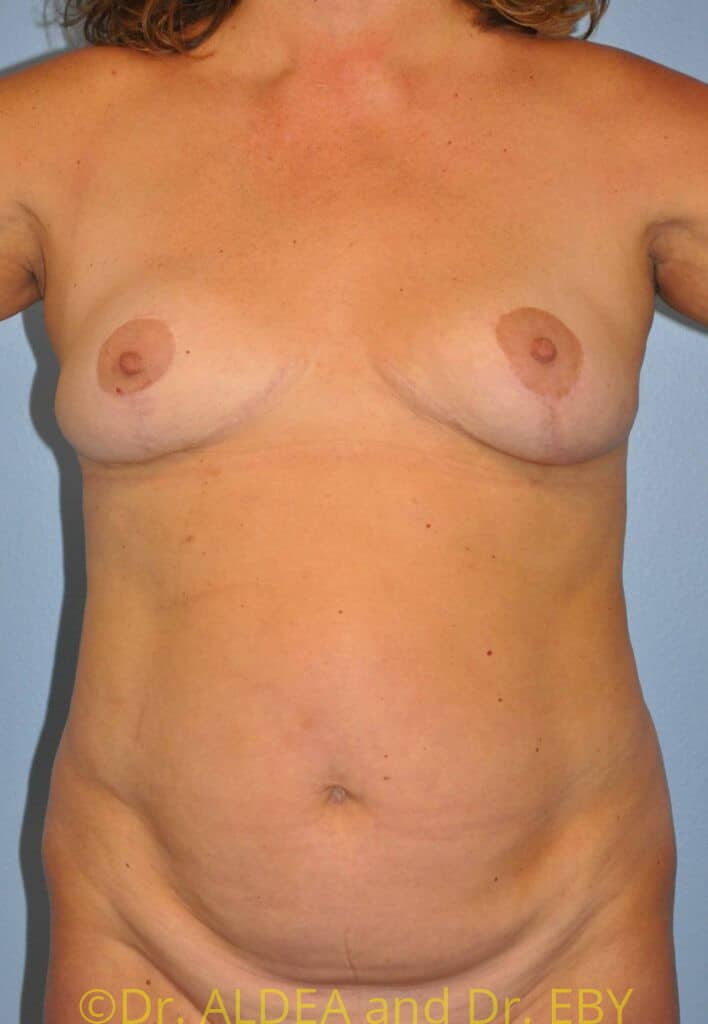 Before Image: Liposuction #877 - front