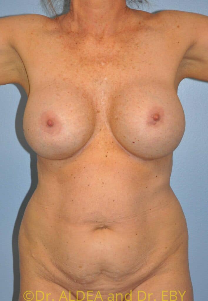 Before Image: Mommy Makeover #200 - front