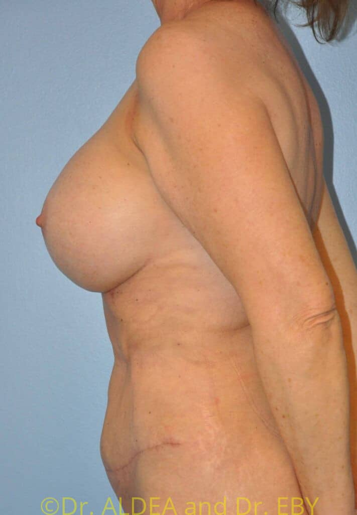 After Image: Mommy Makeover #200 - left-side
