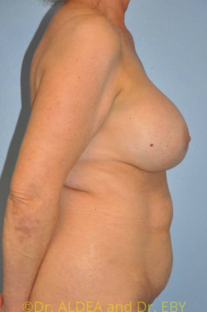 Before Image: Mommy Makeover #200 - right-side