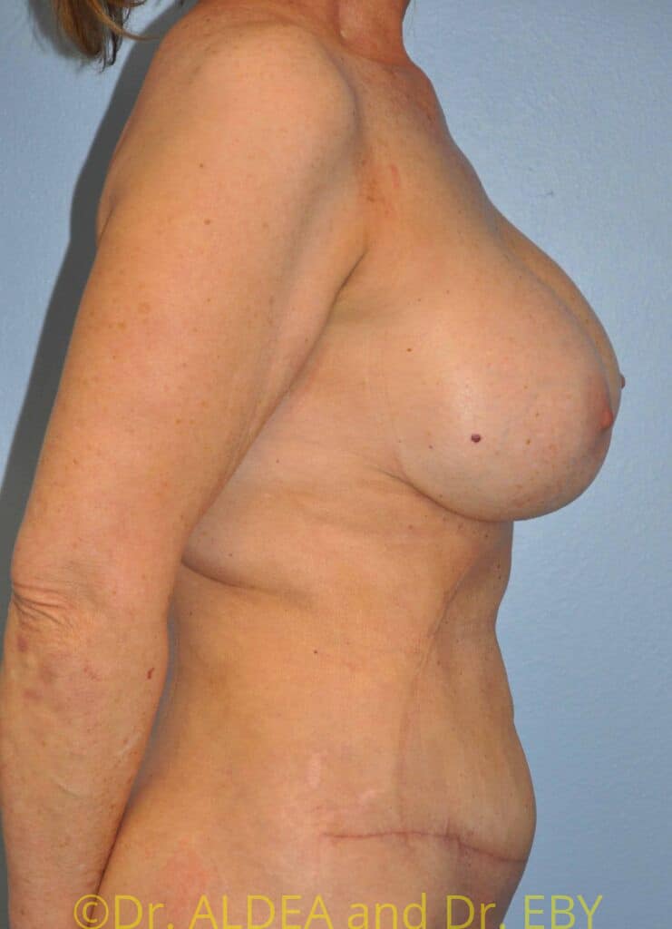 After Image: Mommy Makeover #200 - right-side