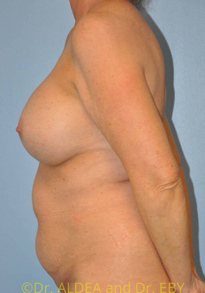 Before Image: Mommy Makeover #200 - left-side